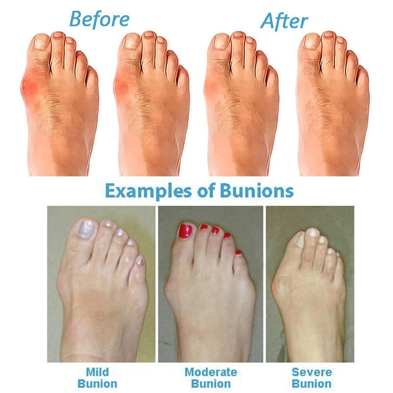 Sandales orthopédiques correctrices de hallux valgus pour femmes avec soutien de la voûte plantaire et cuir PU